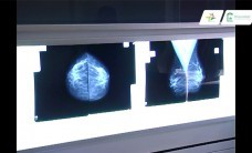 Profilaktyka i leczenie choroby nowotworowej piersi - Wojewódzki Szpital Zespolony w Elblagu